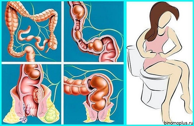 Запор После Секса