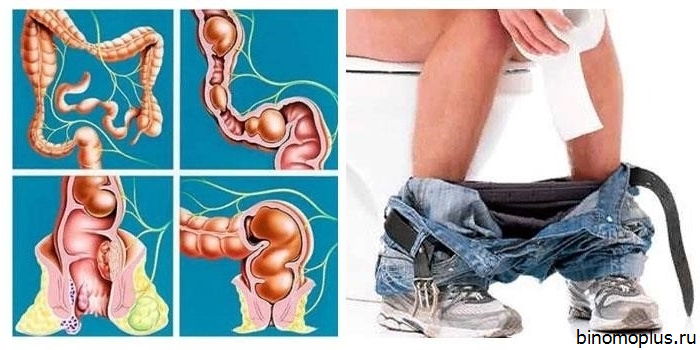 Запор После Секса